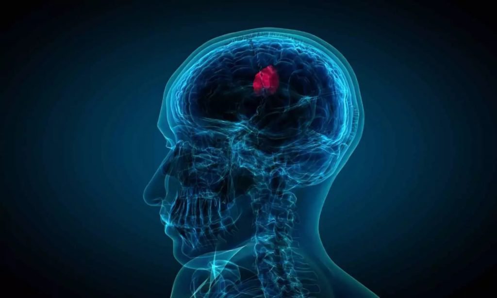 گلیوبلاستوما 